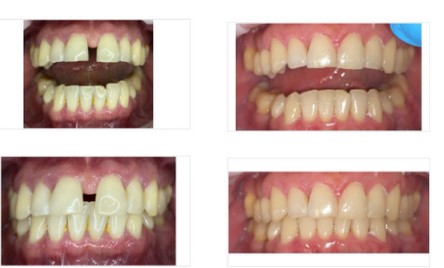 Folije za ispravljanje zuba pre i posle - Smile Revolution galerija